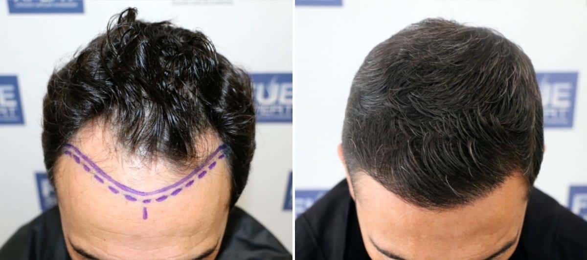 Antes y Después 2444 Injertos- Trasplante capilar FUE - Dr Juan Couto en clínica capilar FUExpert Clinic - Madrid, España
