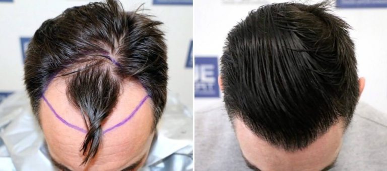 Antes y Después 2500 Injertos- Trasplante capilar FUE - Dr Juan Couto en clínica capilar FUExpert Clinic - Madrid, España