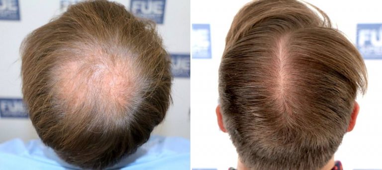 Antes y Después 2500 Injertos- Trasplante capilar FUE - Dr Juan Couto en clínica capilar FUExpert Clinic - Madrid, España