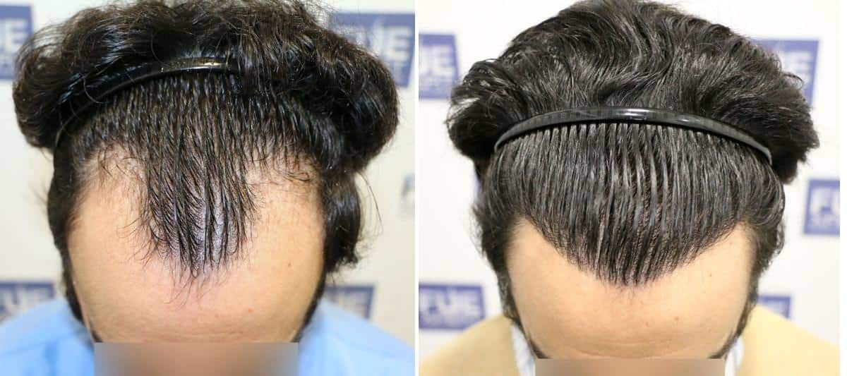 Antes y Después 2504 Injertos- Trasplante capilar FUE - Dr Juan Couto en clínica capilar FUExpert Clinic - Madrid, España