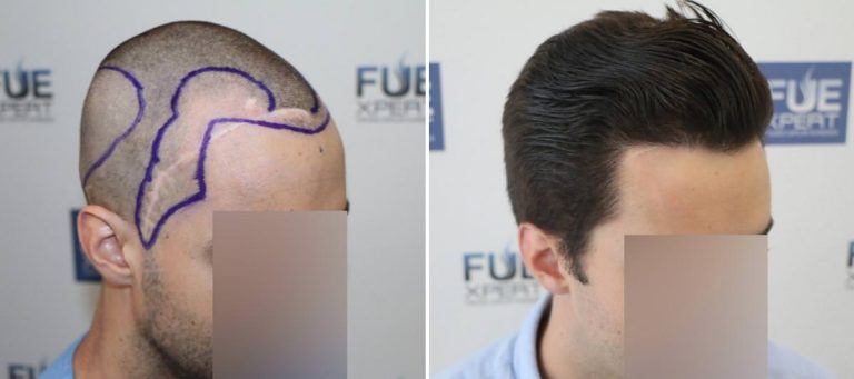 Antes y Después 2516 Injertos- Trasplante capilar FUE - Dr Juan Couto en clínica capilar FUExpert Clinic - Madrid, España