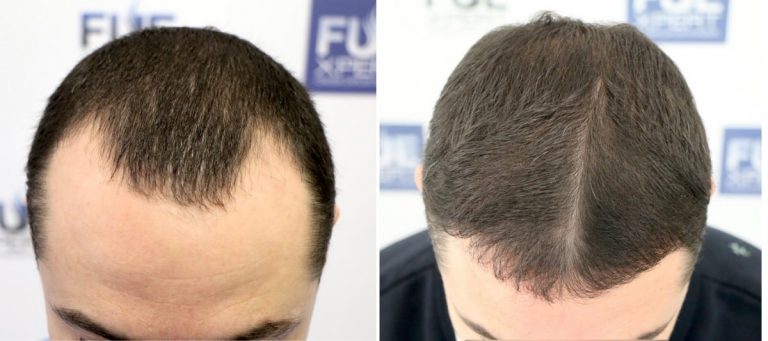 Antes y Después 2540 Injertos- Trasplante capilar FUE - Dr Juan Couto en clínica capilar FUExpert Clinic - Madrid, España