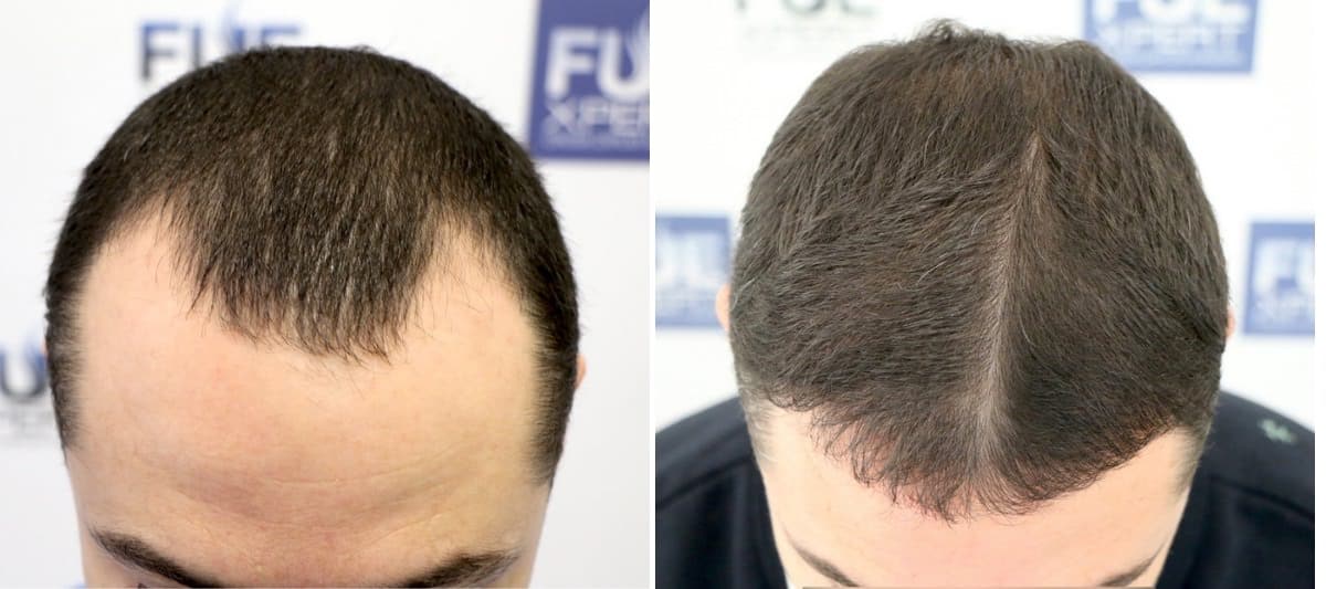 Antes y Después 2540 Injertos- Trasplante capilar FUE - Dr Juan Couto en clínica capilar FUExpert Clinic - Madrid, España