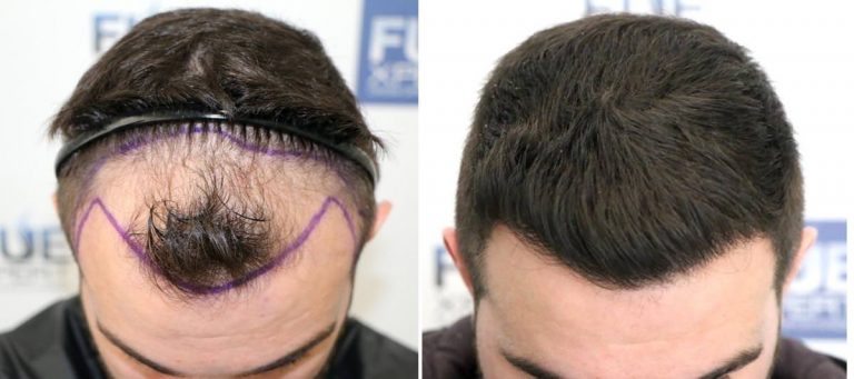 Antes y Después 2593 Injertos- Trasplante capilar FUE - Dr Juan Couto en clínica capilar FUExpert Clinic - Madrid, España