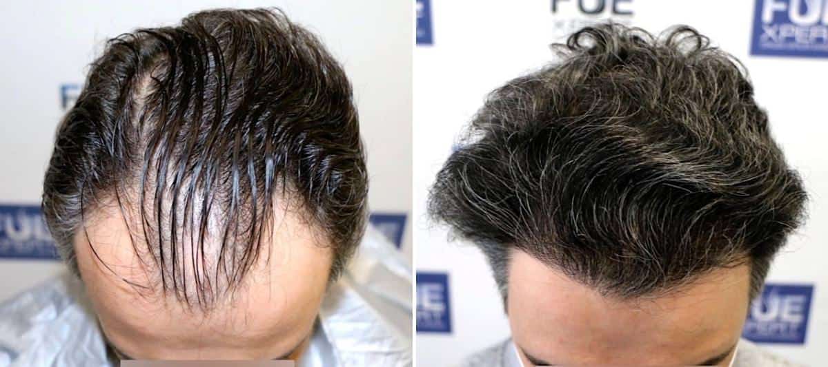 Antes y Después 2700 Injertos- Trasplante capilar FUE - Dr Juan Couto en clínica capilar FUExpert Clinic - Madrid, España