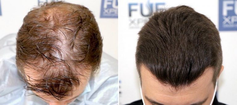 Antes y Después 2700 Injertos- Trasplante capilar FUE - Dr Juan Couto en clínica capilar FUExpert Clinic - Madrid, España