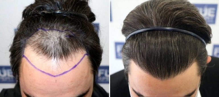 Antes y Después 2700 Injertos- Trasplante capilar FUE - Dr Juan Couto en clínica capilar FUExpert Clinic - Madrid, España