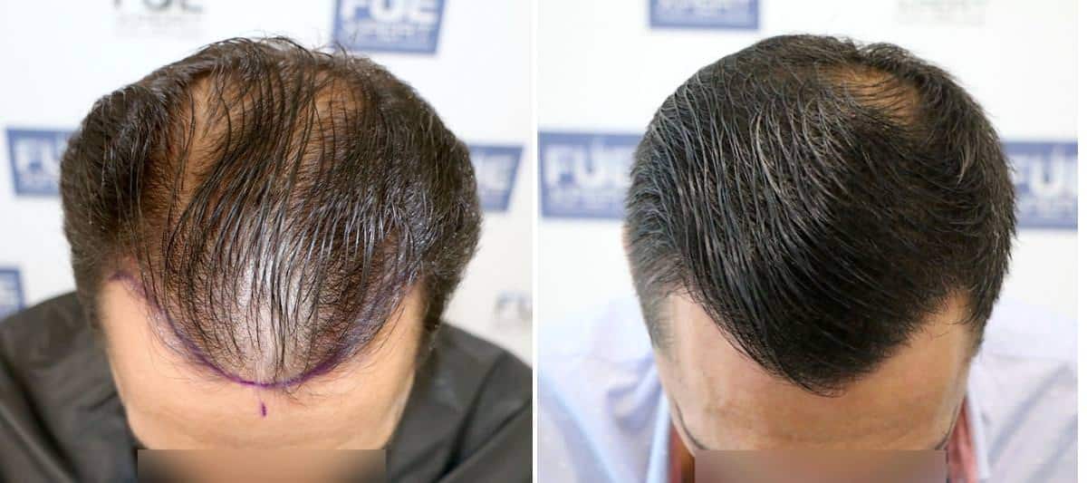 Antes y Después 2714 Injertos- Trasplante capilar FUE - Dr Juan Couto en clínica capilar FUExpert Clinic - Madrid, España