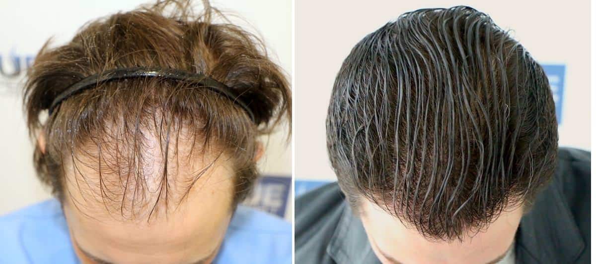 Antes y Después 2951 Injertos- Trasplante capilar FUE - Dr Juan Couto en clínica capilar FUExpert Clinic - Madrid, España