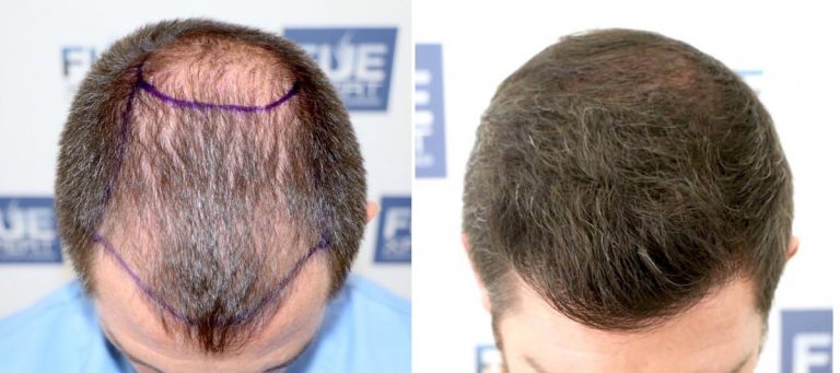 Antes y Después 3000 Injertos- Trasplante capilar FUE - Dr Juan Couto en clínica capilar FUExpert Clinic - Madrid, España