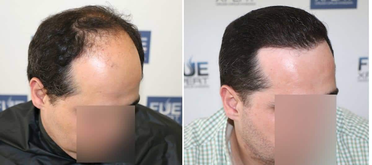 Antes y Después 3000 Injertos- Trasplante capilar FUE - Dr Juan Couto en clínica capilar FUExpert Clinic - Madrid, España
