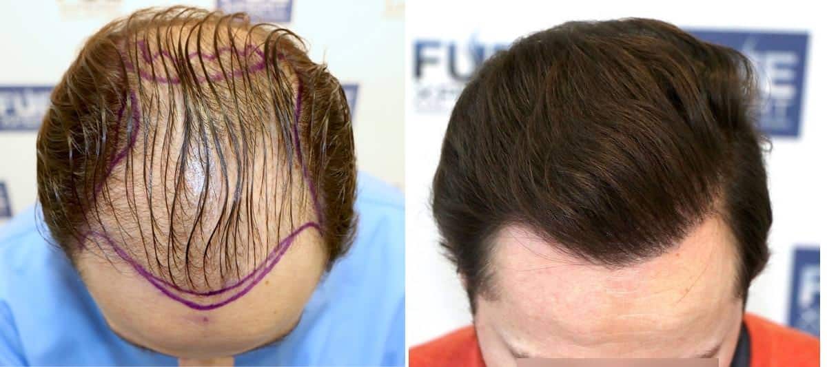 Antes y Después 3000 Injertos- Trasplante capilar FUE - Dr Juan Couto en clínica capilar FUExpert Clinic - Madrid, España