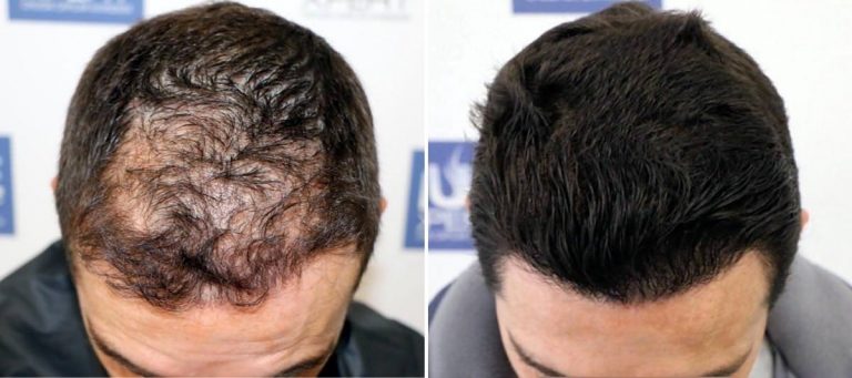 Antes y Después 3004 Injertos- Trasplante capilar FUE - Dr Juan Couto en clínica capilar FUExpert Clinic - Madrid, España