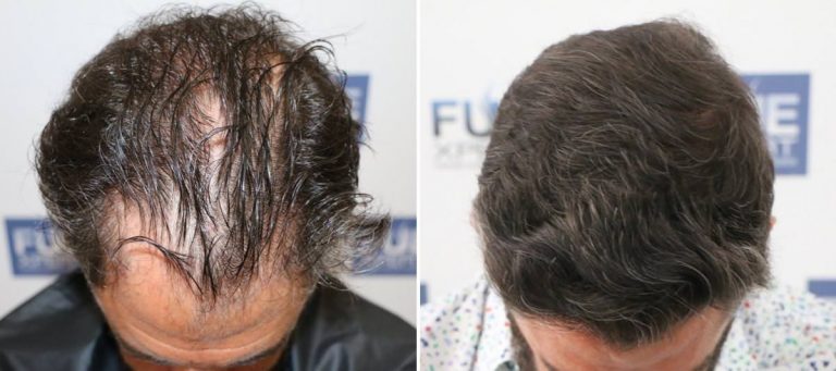 Antes y Después 3014 Injertos- Trasplante capilar FUE - Dr Juan Couto en clínica capilar FUExpert Clinic - Madrid, España