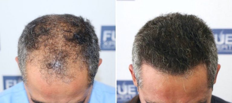 Antes y Después 3034 Injertos- Trasplante capilar FUE - Dr Juan Couto en clínica capilar FUExpert Clinic - Madrid, España