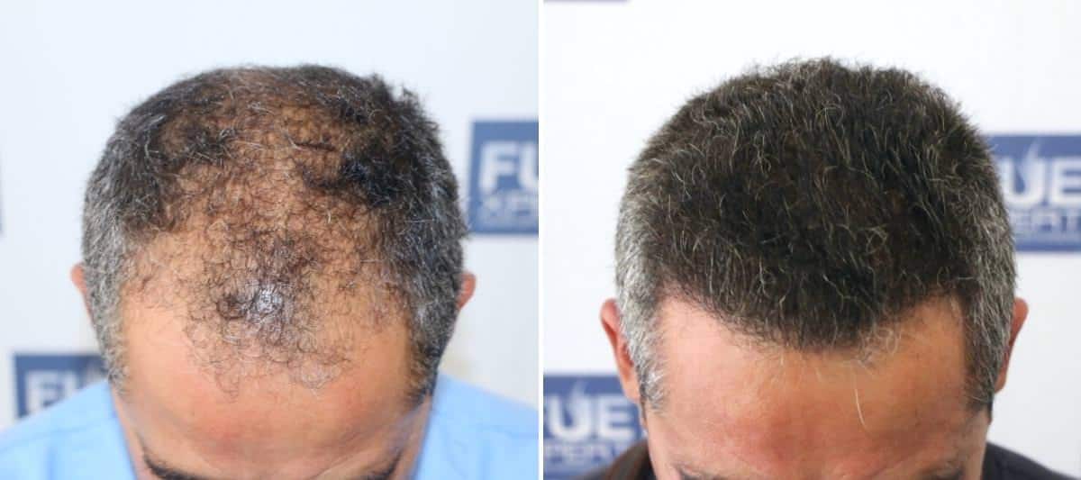 Antes y Después 3034 Injertos- Trasplante capilar FUE - Dr Juan Couto en clínica capilar FUExpert Clinic - Madrid, España
