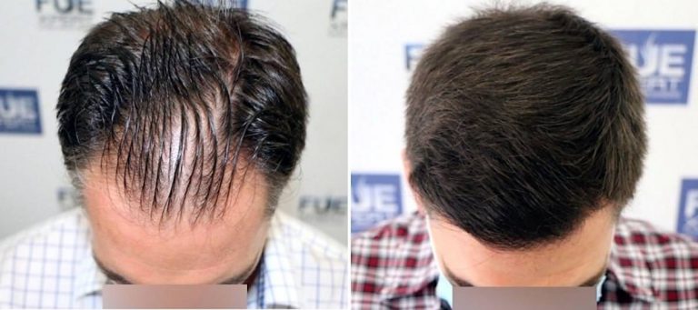Antes y Después 3038 Injertos- Trasplante capilar FUE - Dr Juan Couto en clínica capilar FUExpert Clinic - Madrid, España