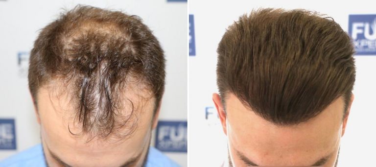 Antes y Después 3052 Injertos- Trasplante capilar FUE - Dr Juan Couto en clínica capilar FUExpert Clinic - Madrid, España