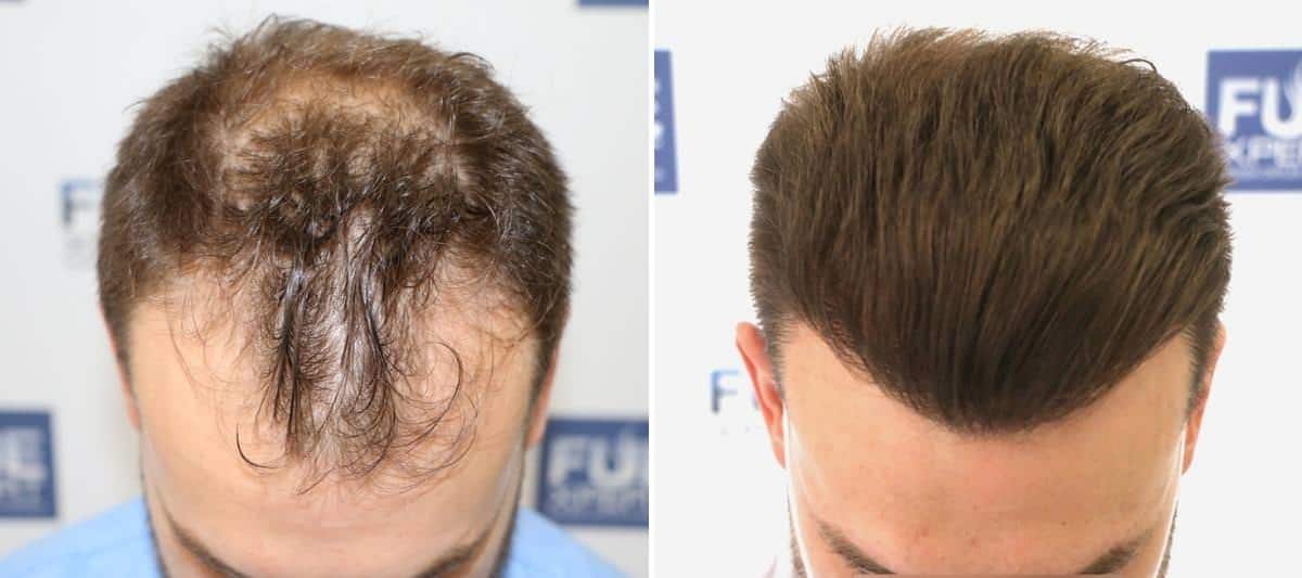 Antes y Después 3052 Injertos- Trasplante capilar FUE - Dr Juan Couto en clínica capilar FUExpert Clinic - Madrid, España