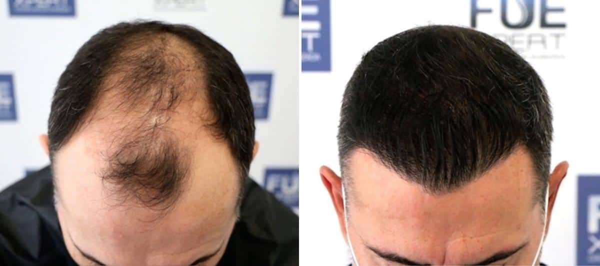 Antes y Después 3070 Injertos- Trasplante capilar FUE - Dr Juan Couto en clínica capilar FUExpert Clinic - Madrid, España