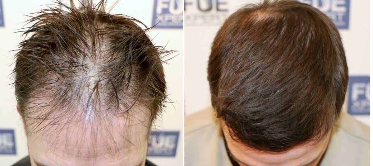 Antes y Después 3205 Injertos- Trasplante capilar FUE - Dr Juan Couto en clínica capilar FUExpert Clinic - Madrid, España