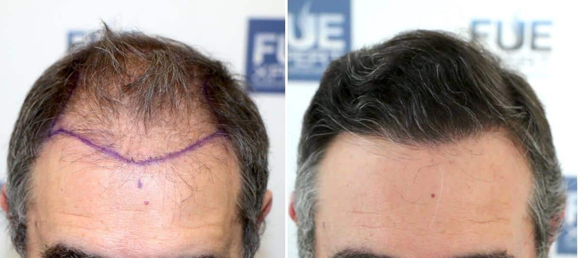 Antes y Después 3210 Injertos- Trasplante capilar FUE - Dr Juan Couto en clínica capilar FUExpert Clinic - Madrid, España