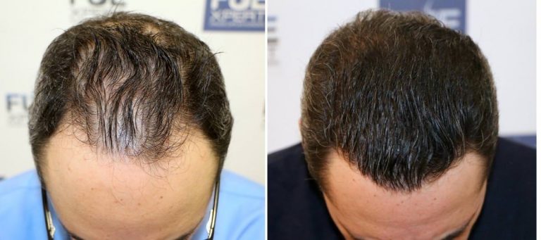 Antes y Después 3241 Injertos- Trasplante capilar FUE - Dr Juan Couto en clínica capilar FUExpert Clinic - Madrid, España