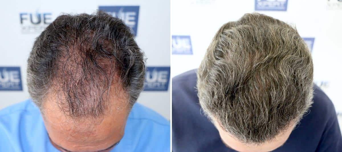 Antes y Después 3250 Injertos- Trasplante capilar FUE - Dr Juan Couto en clínica capilar FUExpert Clinic - Madrid, España