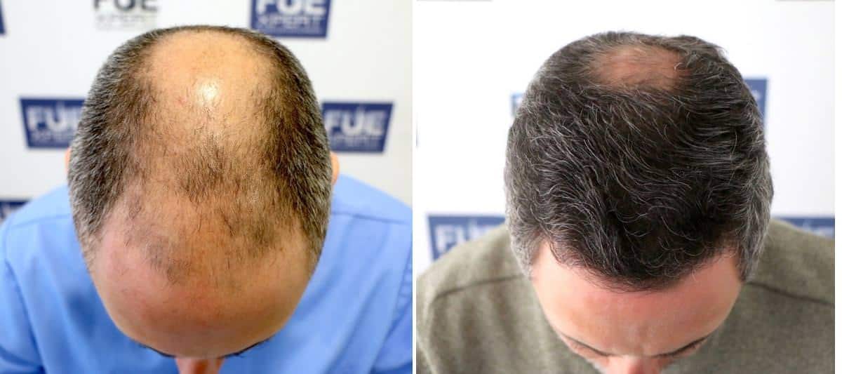 Antes y Después 3268 Injertos- Trasplante capilar FUE - Dr Juan Couto en clínica capilar FUExpert Clinic - Madrid, España