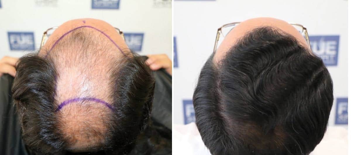 Antes y Después 3500 Injertos- Trasplante capilar FUE - Dr Juan Couto en clínica capilar FUExpert Clinic - Madrid, España