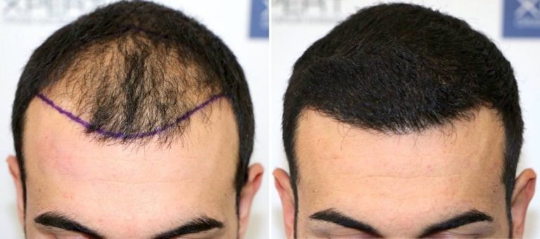 Antes y Después 3590 Injertos- Trasplante capilar FUE - Dr Juan Couto en clínica capilar FUExpert Clinic - Madrid, España