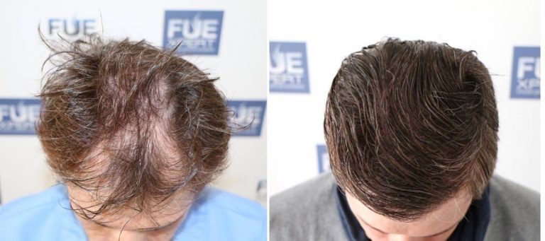 Antes y Después 4012 Injertos- Trasplante capilar FUE - Dr Juan Couto en clínica capilar FUExpert Clinic - Madrid, España