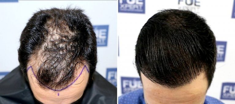 Antes y Después 4017 Injertos- Trasplante capilar FUE - Dr Juan Couto en clínica capilar FUExpert Clinic - Madrid, España
