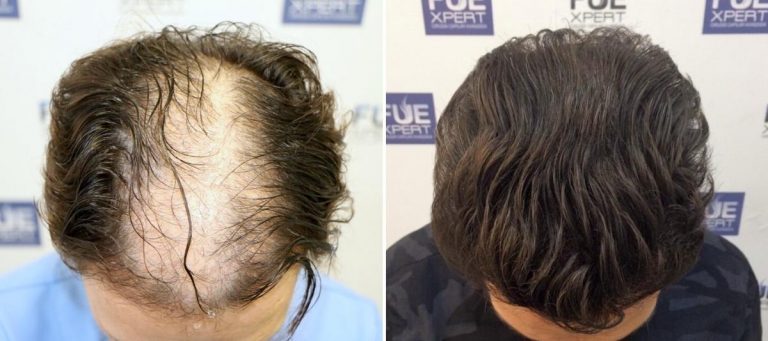 Antes y Después 4200 Injertos- Trasplante capilar FUE - Dr Juan Couto en clínica capilar FUExpert Clinic - Madrid, España