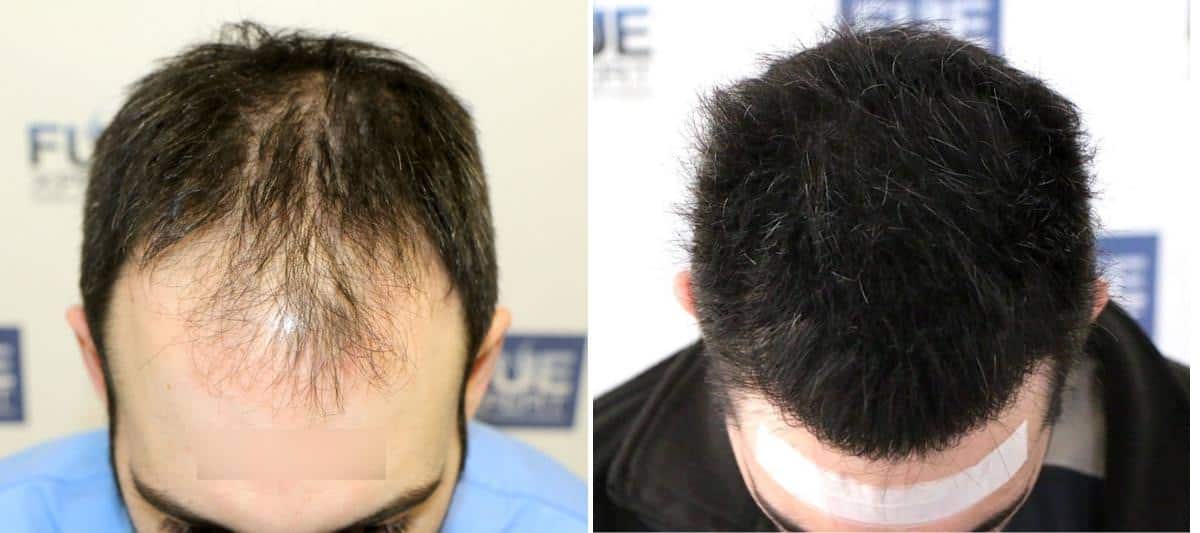 Antes y Después 4467 Injertos- Trasplante capilar FUE - Dr Juan Couto en clínica capilar FUExpert Clinic - Madrid, España
