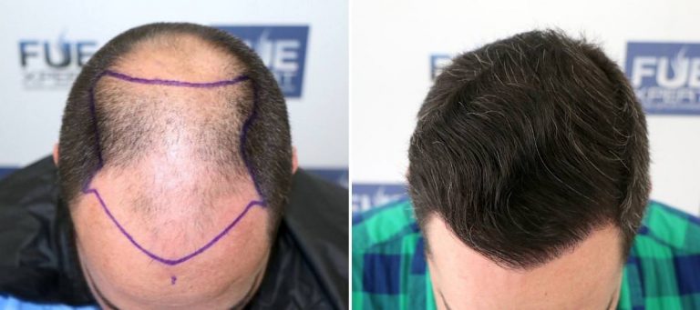 Antes y Después 4766 Injertos- Trasplante capilar FUE - Dr Juan Couto en clínica capilar FUExpert Clinic - Madrid, España