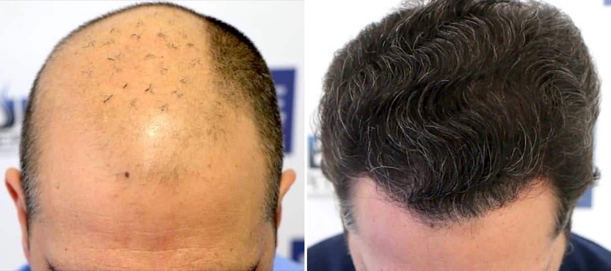 Antes y Después 5805 Injertos- Trasplante capilar FUE - Dr Juan Couto en clínica capilar FUExpert Clinic - Madrid, España