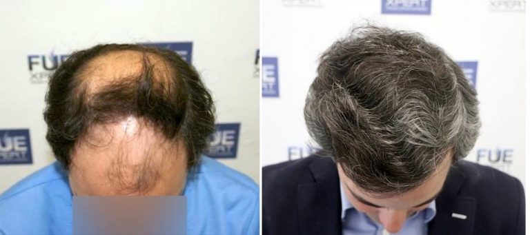 Antes y Después - 5886 Injertos- Trasplante capilar FUE - Dr Juan Couto en clínica capilar FUExpert Clinic - Madrid, España