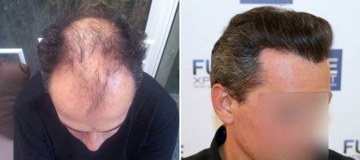 Antes y Después 5964 Injertos- Trasplante capilar FUE - Dr Juan Couto en clínica capilar FUExpert Clinic - Madrid, España