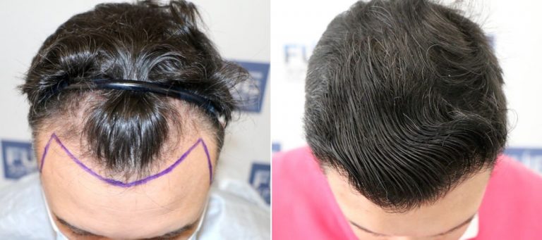 Antes Después 2305 Injertos - Trasplante Capilar FUE en FUExpert Clinic por el Dr Juan Couto - Madrid, España 1200