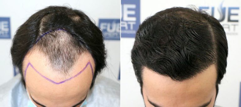 Antes y Después 3000 Injertos - Trasplante capilar FUE - Dr Juan Couto en clínica capilar FUExpert Clinic - Madrid, España 1200