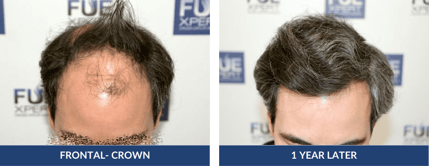 Before After Hair Transplant 5886 Grafts in Madrid by Dr. Juan Couto at FUExpert Clinic – Best Hair Transplant Clinic in Madrid, Spain, and the World 2 PHOTOS