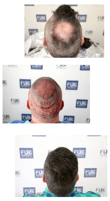 El-Mejor-Trasplante-Cpilar-Coronillas-en-Madrid-Espana-por-el-Dr-Juan-Couto-en-FUExpert-Clinic-2