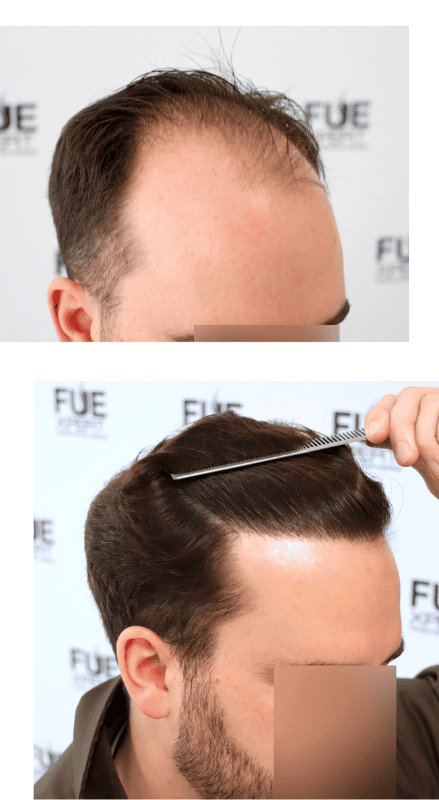El-Mejor-Trasplante-Cpilar-de-primeras-lineasen-Madrid-Espana-por-el-Dr-Juan-Couto-en-FUExpert-Clinic