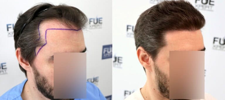 Trasplante Capilar FUE 3217 Injertos