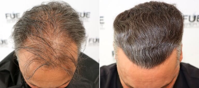 Antes-Despues-Trasplante-Capilar-3000-Grafts-por-el-Dr-Juan-Couto-en-FUExpert-Clinic-en-clinica-capilar-en-Madrid-FUExpert-Clinic