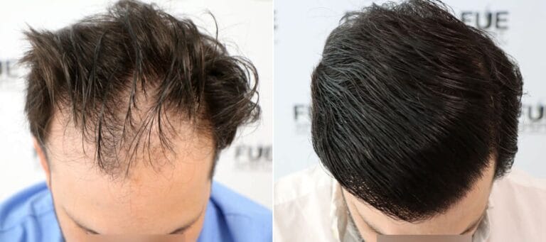 4100 Grafts Injerto Capilar en Madrid por el Dr Juan Couto en FUExpert Clinic