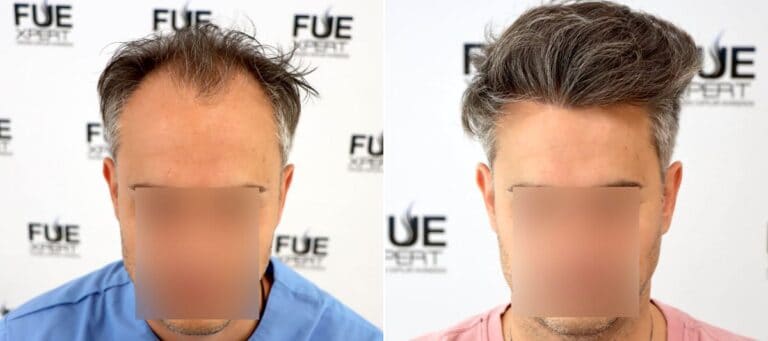 Before and after Hair Transplant in Madrid by Dr. Juan Couto, FUExpert Clinic