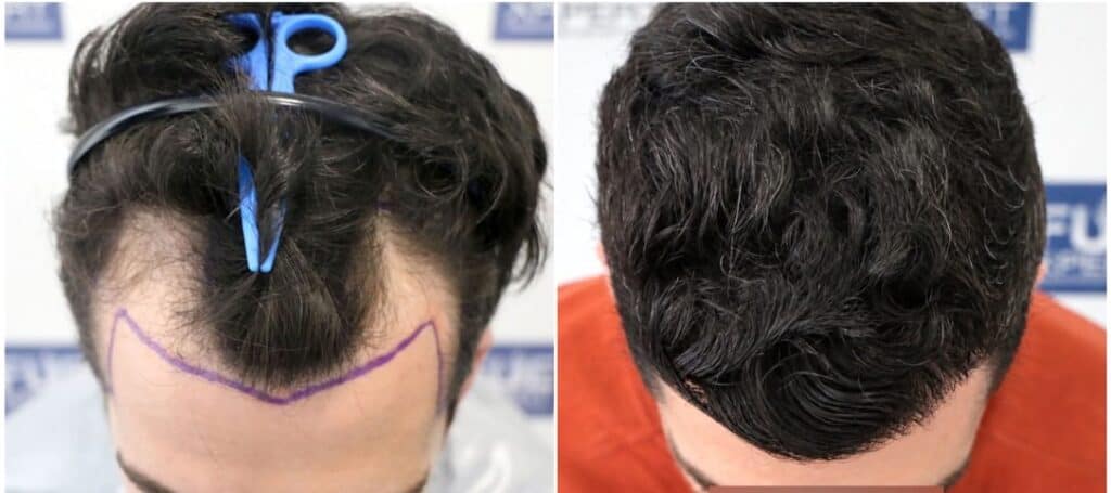 Antes-Despues-Injerto-Capilar-en-Madrid-2100-Grafts-por-Dr-Juan-Couto-FUExpert-Clinic-2